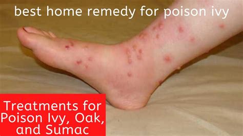 Best Home Remedy For Poison Ivy Treatments For Poison Ivy Oak And