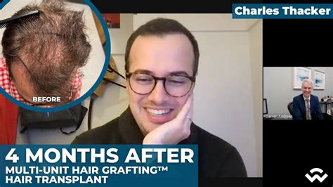 Multi Unit Hair Grafting Hair Transplant Months After Virtual