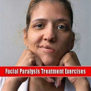 Best 5 Useful Facial Paralysis Treatment Exercises For You