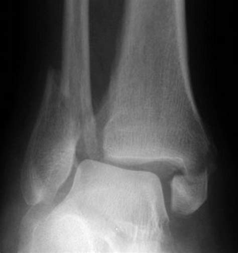 Malleolus Fracture / Operative Treatment Of Posterior Malleolar ...