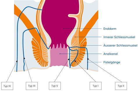 Anal Fistulas Usz