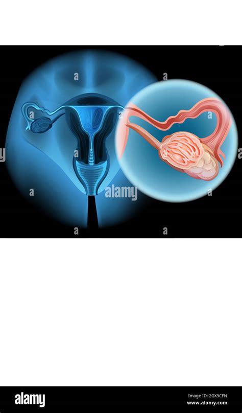 Ovarian Cancer Diagram In Woman Stock Vector Image And Art Alamy