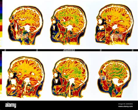 Brain MRI Scans Farbige Magnetresonanztomographie MRT Scans Von