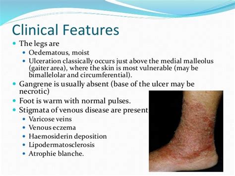 Venous Ulceers