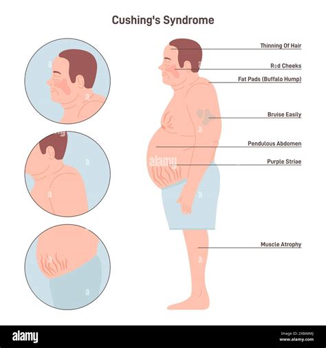 Cushings Syndrome Excess Cortisol Production Male Figure With