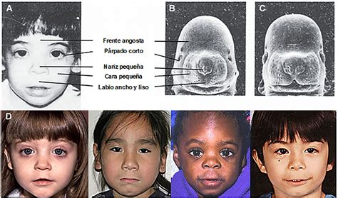 El Síndrome Fetal Alcohólico nada menos