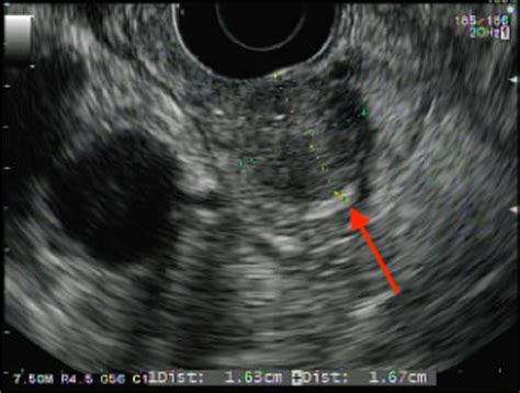Eus 82013 Initial Diagnosis Arrow Pointing To 16 Cm × 16 Cm