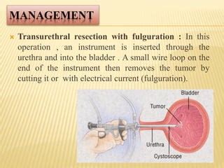 Baldder cancer (Bladder carcinoma) | PPT