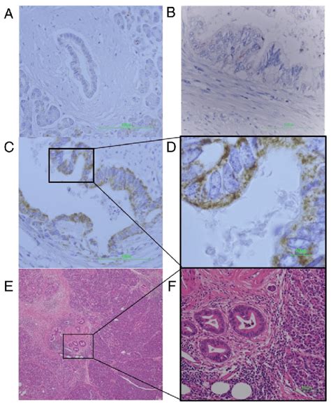 Ihc Of Pdac Tissue Observed By Light Microscope A A Normal Pancreas