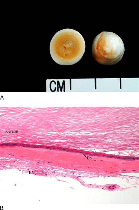 Epidermoid Cyst Of The Testicle Urology