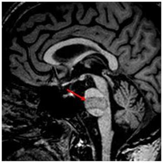 Mri Of A Patient With Locked In Syndrome Due To Basilar Thrombosis