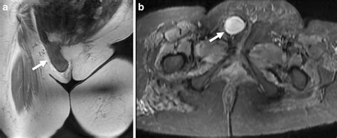 Canal Of Nuck Hernia A Multimodality Imaging Review Springerlink