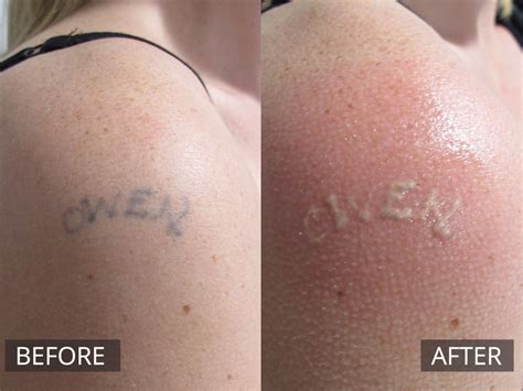 Remove Tattoo Cream Before And After Wiki Tattoo