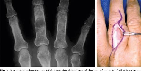 Hand Tumors Ii Benign And Malignant Bone Tumors Of The Hand