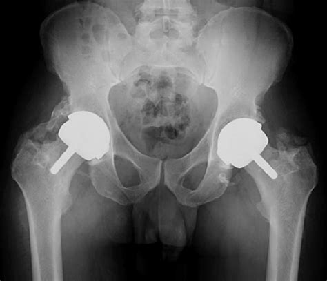 Ap Pelvis Radiograph Demonstrating Bilateral Hip Resurfacings With