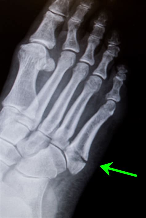 Metatarsal Fracture Foot - Friendly Foot Care PC