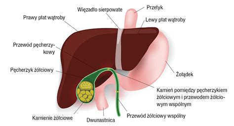 Chirurgia po Dyplomie Kamica pęcherzyka żółciowego