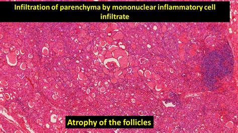 Hashimotos Thyroiditis Pathology Made Simple