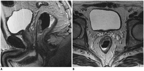 High Resolution Turbo Spin Echo T Weighted Scans On Sagittal A And