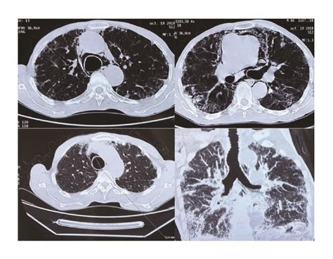 CT Scan Showing Tracheal And Both Main Bronchi Dilation With Associated