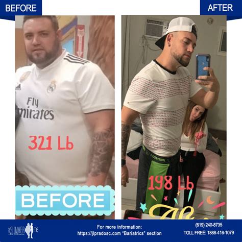 Before And After Bariatrics Jl Prado Surgical Center