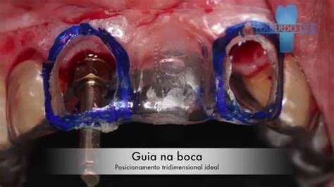 Guia Cir Rgico Anterior Para Cirurgia De Instala O De Implante