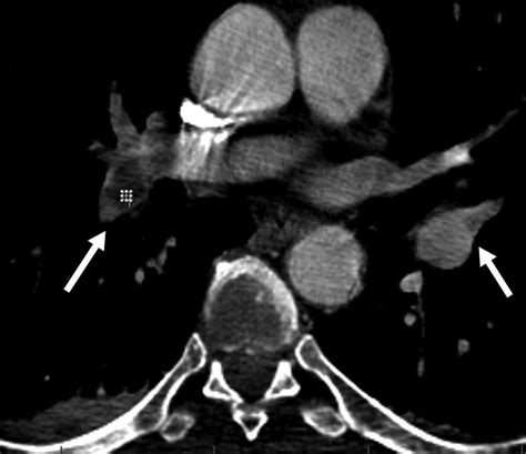 Nonthrombotic Pulmonary Embolism Ajr