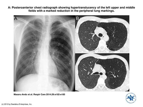 A Posteroanterior Chest Radiograph Showing Hypertranslucency Of The