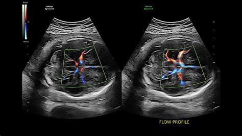 Voluson Signature 20 For Women S Health Ultrasound Ge Healthcare