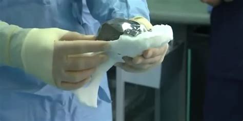 3d Printed Hip Implant Saves Woman From Pain And Disfigurement Video