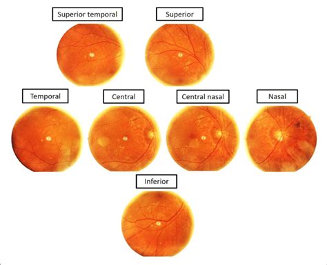 Seven Different 45° × 40° Retinal Fields Captured Download Scientific Diagram