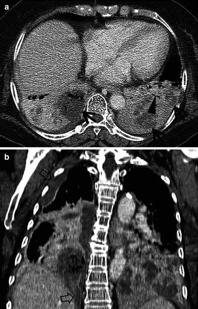 Pneumonia Radiology Key