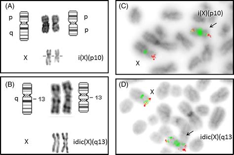 Isolated Isochromosomes Ixp10 And Idicxq13 Are Associated With Myeloid Malignancies And