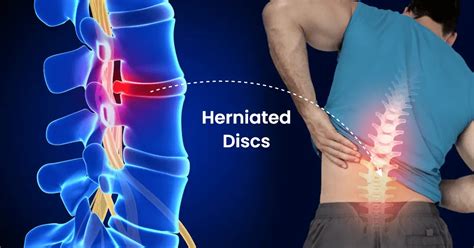 How Long Does A Herniated Disc Take To Heal Michael Rock MD Chicago