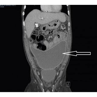 A Computed Tomography Ct Abdomen Pelvis Cross Sectional View