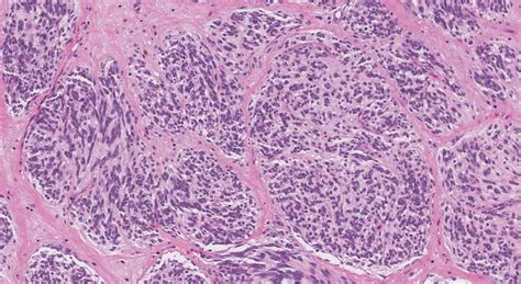 Cellular Neurothekeoma Ottawa Atlas Of Pathology