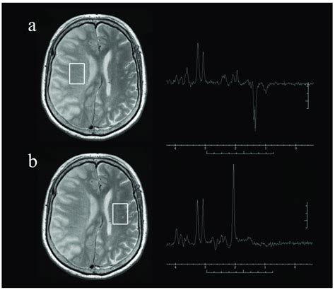 Representative Axial T2 Weighted Magnetic Resonance Images And