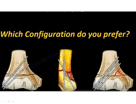 Supracondylar Fractures Of The Humerus In Children