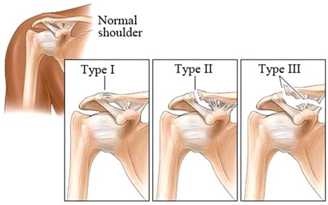 Acromioclavicular Ac Joint Injuries Mt Physiotherapy Porn Sex Picture