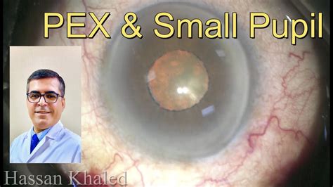 Phacoemulsification Of Dense Cataract With PEX And Small Pupil YouTube