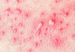 What Is Skin Rash Symptoms Causes Treatment In Nyc