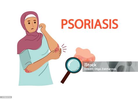 Psoriasis Symptoms And Reasons Infographic Human Skin Infection