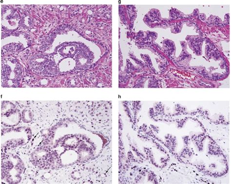 Erg Oncoprotein Expression In Prostate Cancer Clonal Progression Of Erg Positive Tumor Cells