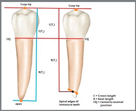 SciELO Brasil Effect Of Orthodontic Forces On Root Length Of