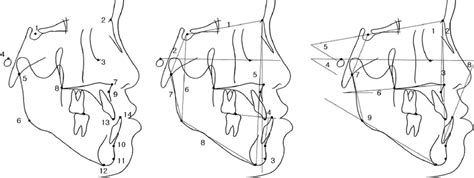 Lateral Cephalometric Analysis Left Lateral Cephalometric Landmarks