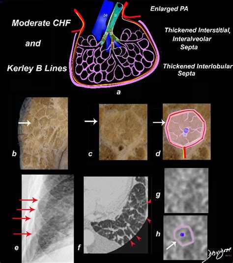 Secondary Lobule | Lungs