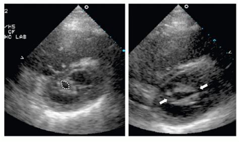 Percutaneous Balloon Mitral Commissurotomy Mitral Repair And Pulmonic