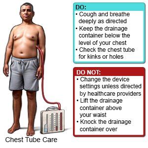 Chest Tube Care at Home - What You Need to Know