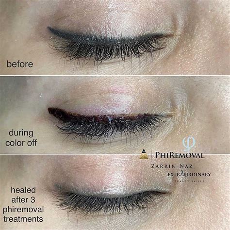 Eyeliner Tattoo Removal - How to Remove Permanent Eyeliner?