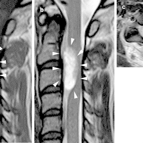 Preoperative Magnetic Resonance Imaging MRI Of The Cervical Spine A